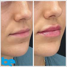 The benefits of lip fillers